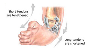 첨내반족 사진, Short tendons are lengthened, Long tendons are shortened